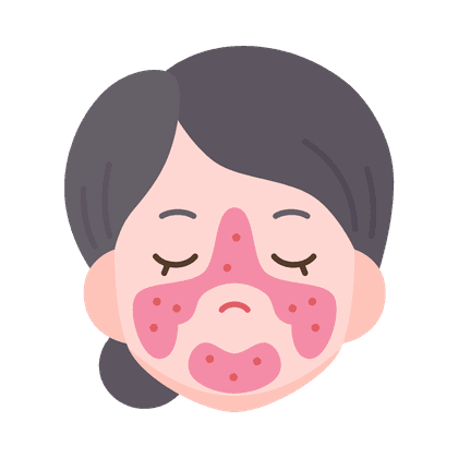 Couperose (spataders)