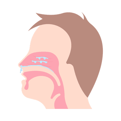 Sinusitis, Stirnhöhlenentzündung, Sinusitis frontalis