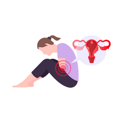 Myome der Gebärmutter