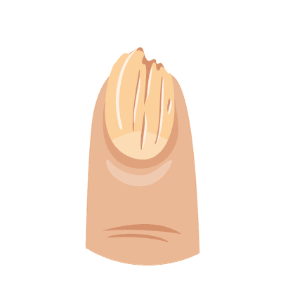 Onycholyse (loslaten van de nagelplaat)