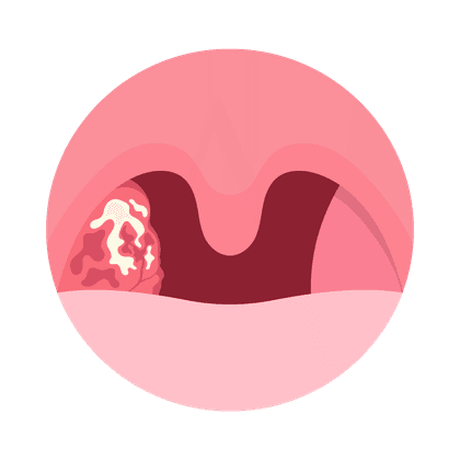 Adenoïden bij kinderen